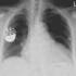 Beültetett pacemaker mellkasi röntgenfelvételen